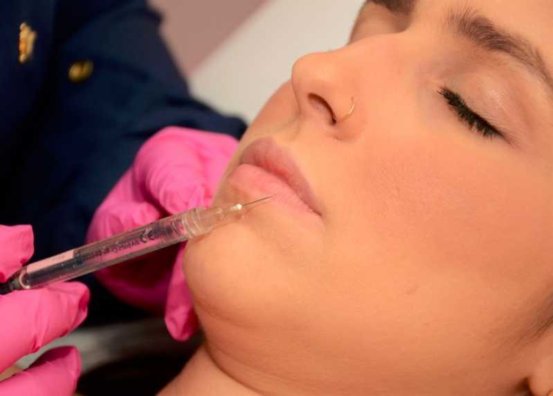 Aplicação de Botox Sorriso Gengival Setor Tancredo Neves - Aplicação de Botox nos Lábios