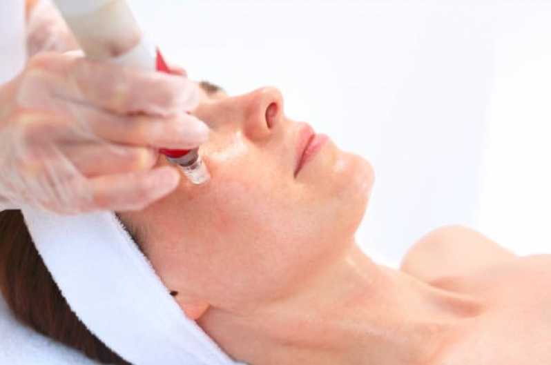 Clínica Especializada em Microagulhamento para Poros Dilatados Granja Santos Dumont - Microagulhamento Facial Goiânia