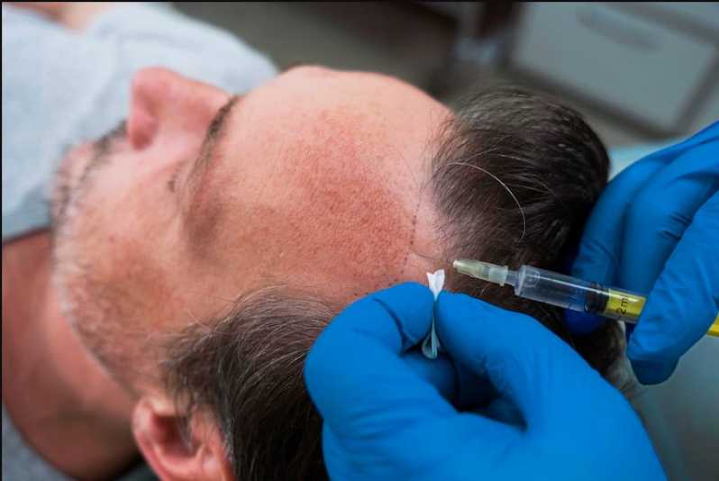 Microagulhamento para Tratamento Capilar Setor Negrão de Lima - Microagulhamento Facial Goiânia