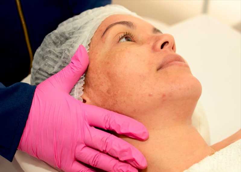 Onde Fazer Tratamento Facial para Manchas Loteamento Portal do Sol I - Tratamento de Rejuvenescimento Facial