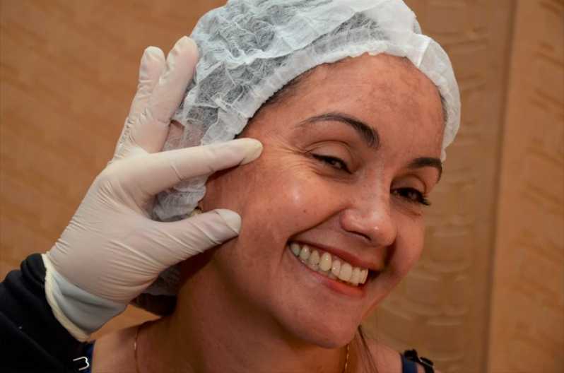 Peeling Facial Químico com Ata Fazenda Caveira - Peeling Facial