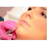 aplicação de botox nos lábios clínica Vila Monticelli