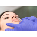 preenchimento com ácido hialurônico no nariz marcar Setor Urias Magalhães II