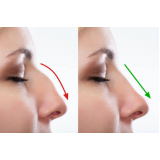 preenchimento do nariz com ácido hialurônico agendar Residencial Kátia