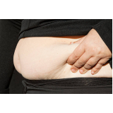 procedimento de endolaser gordura abdômen Silvânia