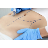 procedimento de endolaser para gordura localizada Setor Negrão de Lima